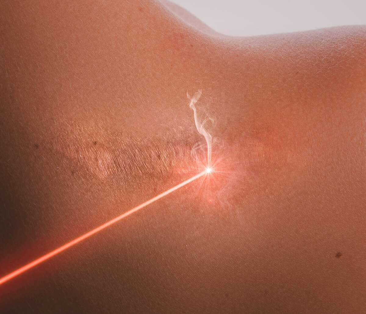 درمان اسکار با تکنیک های لیزر	